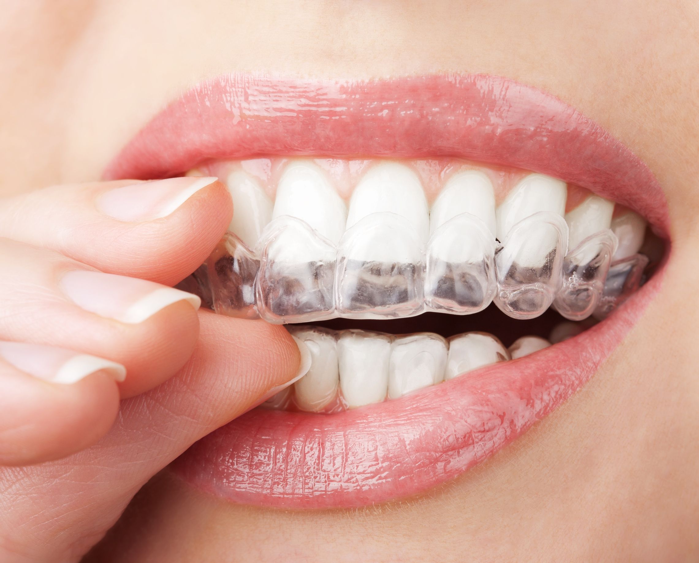 How to Choose the Right Type of Dental Braces in Long Beach, CA
