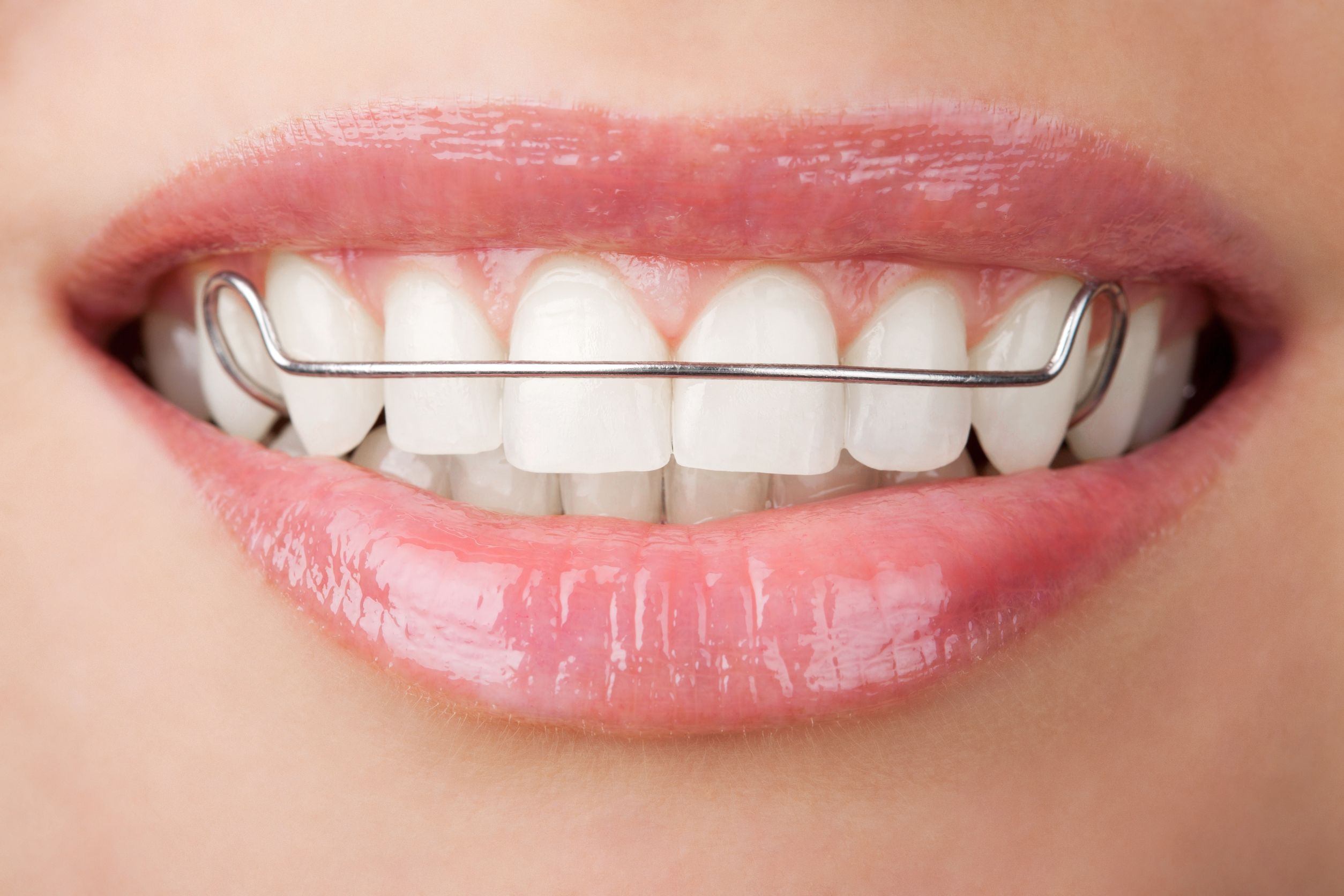 Signs You Need Ceramic Braces in Long Beach, CA