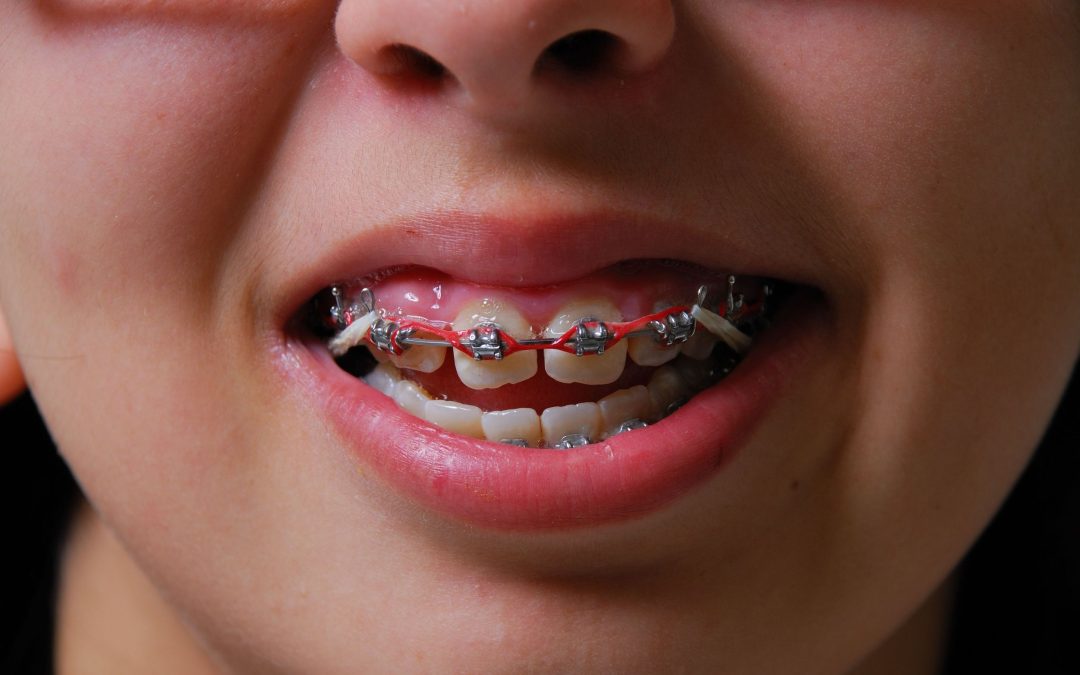 A Confident Smile Starts With Invisalign Treatment In Strongsville, OH