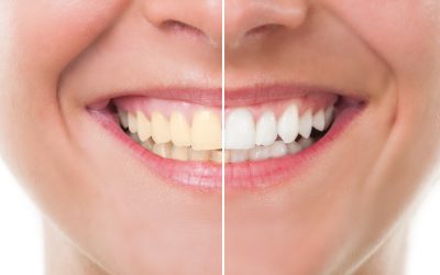 ​Brighten Your Smile with Professional Teeth Whitening Service in Madison, WI